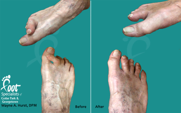 Before and After Pictures - Northwest Austin Georgetown, TX: Foot