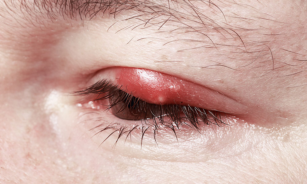 swollen-sore-eyelid-what-could-be-the-problem-atlanta-vision