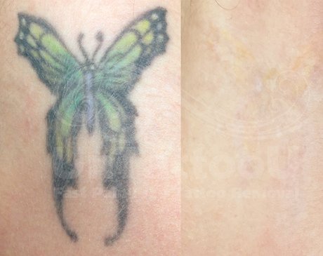untattoou tattoo removal center vienna va untattoou tattoo removal center vienna va
