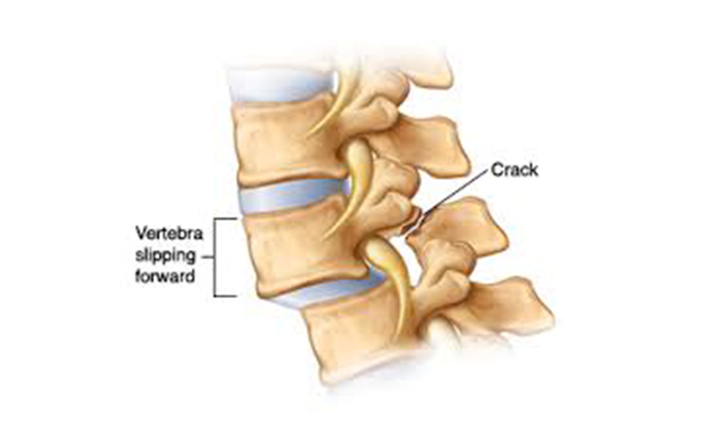 Blog Hudson Valley Scoliosis Correction Center & Strauss Chiropractic Nanuet, NY
