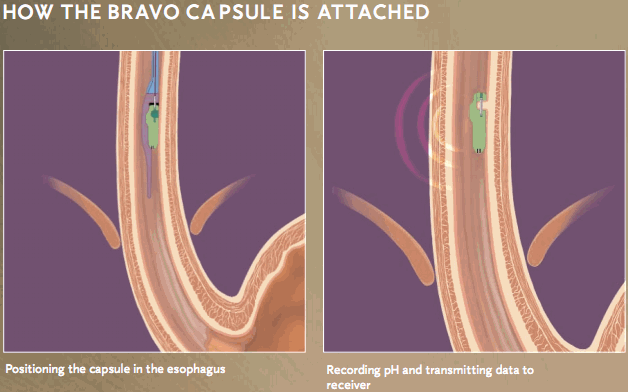 What Is Bravo Test How Does A Bravo PH Test Work UKCDM