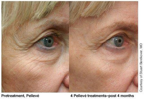 before amp after gallery charlotte nc ballantyne medical before amp after gallery charlotte nc ballantyne medical